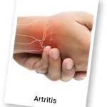 artitris