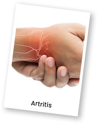 artitris