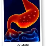 gastritis