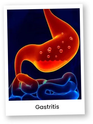 gastritis